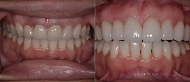 Dental treatment before-after result
