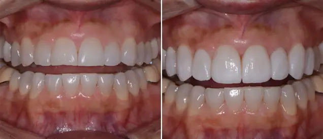 Before-after dental treatment result
